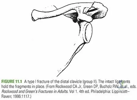 Illustration of clavicle fractures clavicle - Dr. Mohammed Hutaif