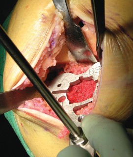 Illustration 23 for Cemented TKA Figure: Your Visual Guide to Surgical Success