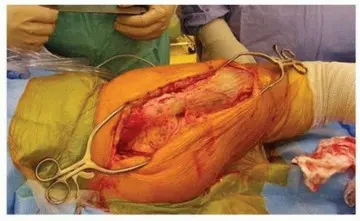 صورة توضيحية لـ تحسين جراحة مراجعة استبدال مفصل الورك الكلي بسيقان التيتانيوم المدببة ذات الفلوس: دليل شامل للمرضى مع الأستاذ الدكتور محمد هطيف