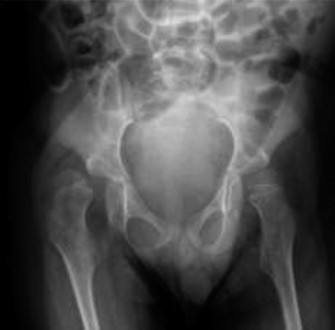 Illustration of children with cerebral - Dr. Mohammed Hutaif