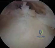 Illustration of nerve entrapment arthroscopic - Dr. Mohammed Hutaif