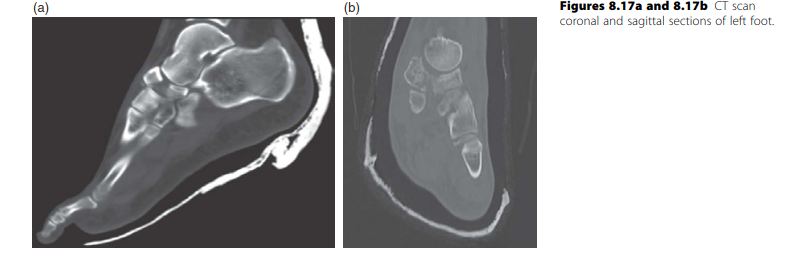 Illustration 2 for Mastering Body of Navicular Fractures: Clinical Case Guide
