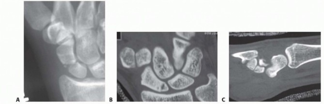 Optimal Fixation of Scaphoid Fractures: A Surgeon's Guide