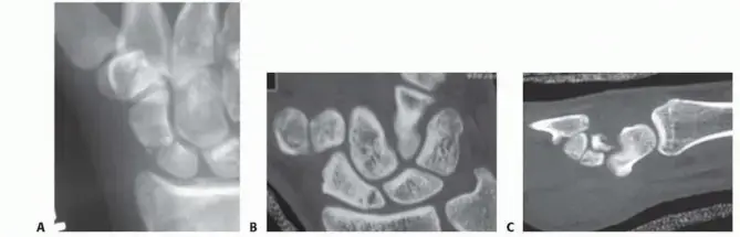 كسر عظم الزورقي في الرسغ: دليلك الشامل للتشخيص والعلاج والتعافي مع الأستاذ الدكتور محمد هطيف