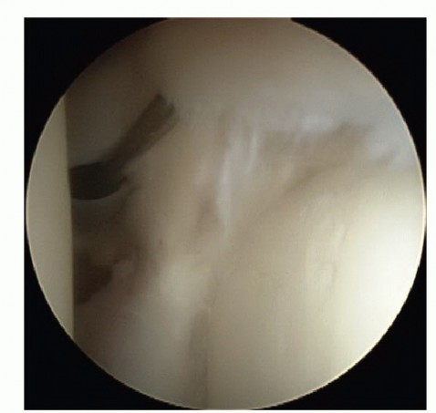 Illustration of superior labral anterior - Dr. Mohammed Hutaif
