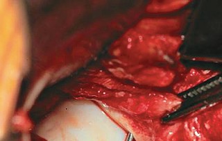 Illustration 65 for Bernese PAO: Unlocking the Procedure with Level V Evidence Insights