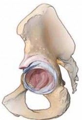 Restore Hip Bone Loss: Stainless Steel Mesh & Impaction Grafting