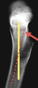 توضيح طبي: استبدال مفصل الورك الكلي بتقنية الإسمنت للفخذ: دليلك الشامل لنتائج تدوم طويلاً مع الأستاذ الدكتور محمد هطيف في صنعاء