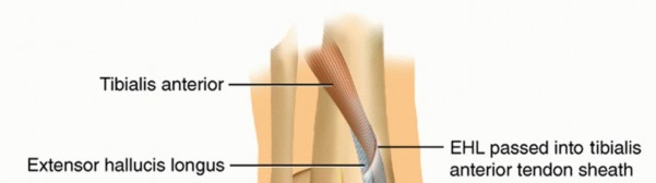 Illustration of tibialis anterior tendon - Dr. Mohammed Hutaif