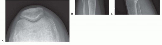 Illustration 2 for Unicondylar Knee Arthroplasty: Is This Your Solution to Knee Pain?