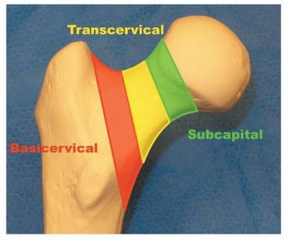 Is a Sliding Hip Screw Best for Your Femoral Neck Fracture?