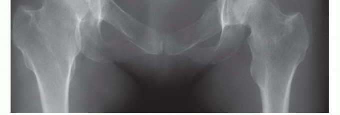 توضيح طبي: جراحة نقائل الحوض: حل شامل لآلام العظام واستعادة الحركة مع الأستاذ الدكتور محمد هطيف