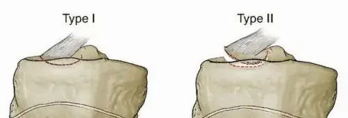 صورة توضيحية لـ كسر شوكة الظنبوب: دليل المريض الشامل للتعافي وعودة الحركة مع الدكتور محمد هطيف