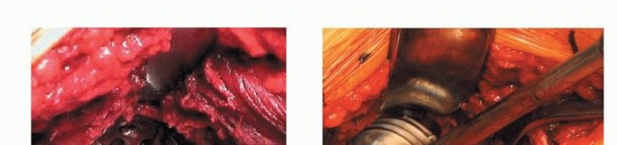 Illustration 7 for Uncemented THA: Critical Soft Tissue Tension for Joint Stability