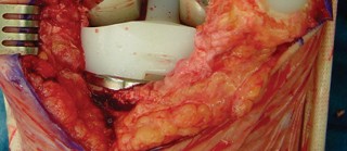 Illustration 34 for Revision of Failed UKA: Your Guide to Successful Treatment