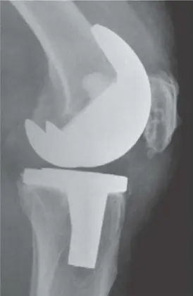 صورة توضيحية لـ التهاب مفصل الركبة الصناعي: دليل شامل للمرضى وخيارات العلاج المتقدمة في صنعاء