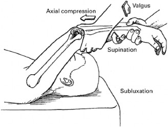 Illustration 3 for Elbow Cases: Unmasking Posterolateral Instability Pain