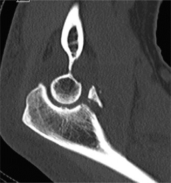 Illustration 69 for Right Shoulder Pain? Avoid This Common X-ray Mistake.