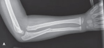 5 Pediatric Fracture Cases: Mastering Reduction and Casting
