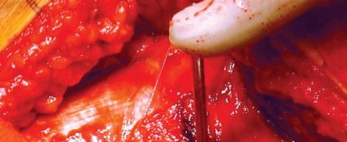 Illustration 24 for Approaches Posterolateral Surgical: A Guide to Enhanced Hip Surgery