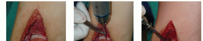 Illustration 16 for Unlock Healing: Medial Malleolar Osteotomy for Talus OLT Allografts