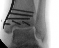 Illustration 30 for Tibial Fracture Extending into the Plafond: Intramedullary Secrets