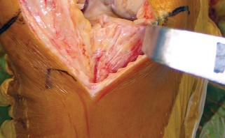 Illustration 12 for Minimize Pain, Maximize Recovery: TKA with Parapatellar
