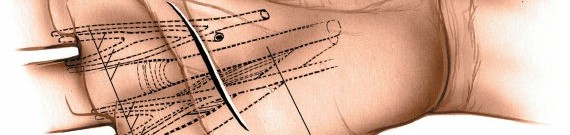 Further illustration of blunt dissection into the deep palmar space