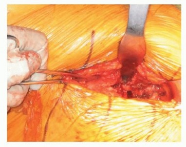 صورة طبية: نصف مفصل الورك: دليلك الشامل لدواعي الاستخدام والأنواع في صنعاء