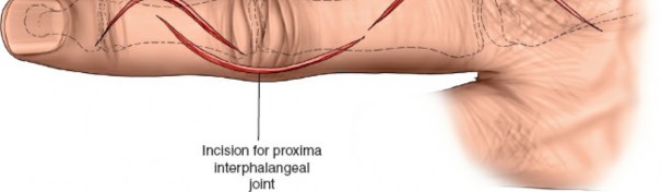Illustration 168 for Essential Surgical Approaches: Uncover Every Aspect of the Wrist