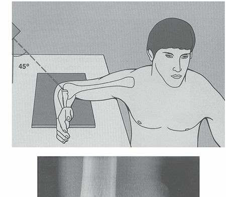Radial Head Fractures: Symptoms, Diagnosis & Recovery