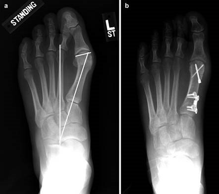 Illustration 66 for First Metatarsal Surgery: Expert Solutions for Foot & Ankle Pain
