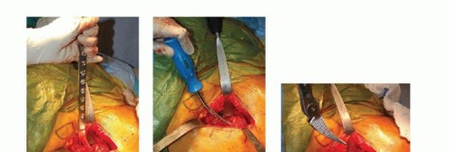 صورة طبية: نصف مفصل الورك: دليلك الشامل لدواعي الاستخدام والأنواع في صنعاء