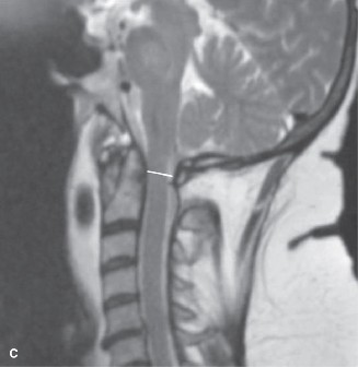 Illustration 11 for Spondylodiscitis: Deciphering the next course of action