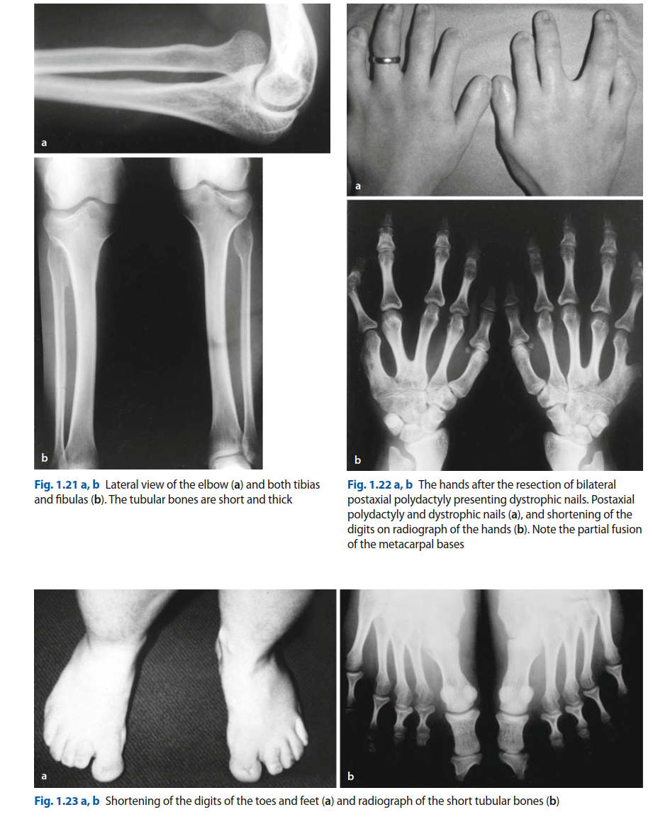 Radiograph demonstrating short long bones and postaxial polydactyly, characteristic skeletal features of Ellis-Van Creveld syndrome.