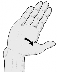 Is Your Wrist Pain Carpal Tunnel Syndrome? Symptoms & Relief Explained