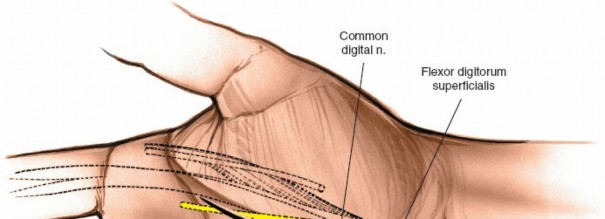 Illustration of drainage of the lateral - Dr. Mohammed Hutaif
