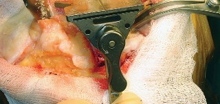 Illustration 41 for Mastering TKA: Essential Methods of Rotational Alignment