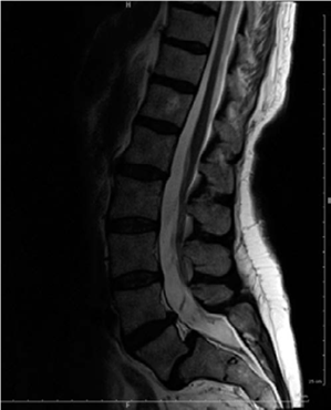 Your Guide to Oral Questions Spondylolisthesis Success