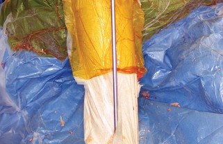 Illustration 28 for Minimize Pain, Maximize Recovery: TKA with Parapatellar