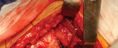 Illustration 4 for Approaches Posterolateral Surgical: A Guide to Enhanced Hip Surgery