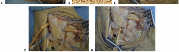 Illustration 21 for Lateral Ankle Repair: Maximize Stability with Interference Screw Fixation