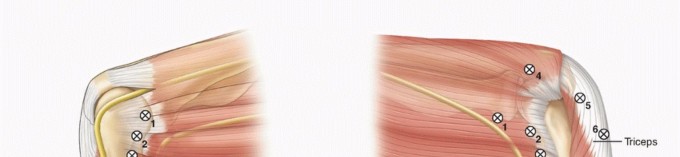 Mastering Elbow Arthroscopy: The Supine Crossbody Position Guide