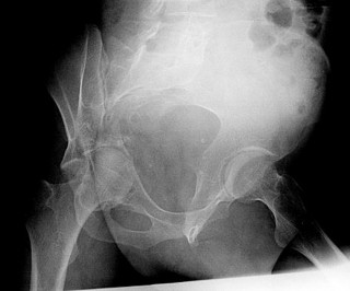 Master Internal Fixation (ORIF) Trauma MCQs Online