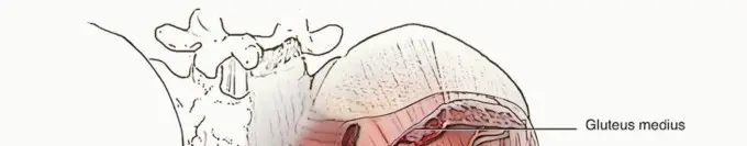 صورة توضيحية لـ استبدال مفصل الورك الكلي: رحلة آمنة لتجنب المضاعفات مع الأستاذ الدكتور محمد هطيف