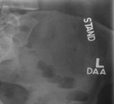 Illustration 3 for Periacetabular Osteotomy: End Hip Pain, Improve Flexion and Internal Motion