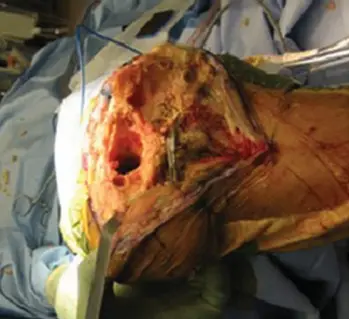 صورة توضيحية لـ جذوع الركبة غير المثبتة بالأسمنت في جراحات المراجعة: دليل شامل للمرضى مع الأستاذ الدكتور محمد هطيف