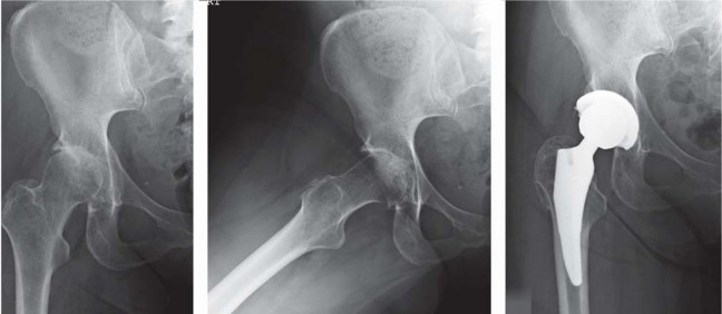 صورة طبية: تقنية الجذع القصير لاستبدال مفصل الورك الكلي: نهج الأستاذ الدكتور محمد هطيف لتدخل جراحي أقل ونتائج أفضل