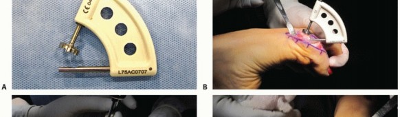Illustration 34 for End Articular Cartilage Loss: Arthrosurface HemiCAP Resurfacing