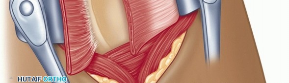 Illustration 26 for Finally Treat Recurrent Posterior Instability of the Shoulder